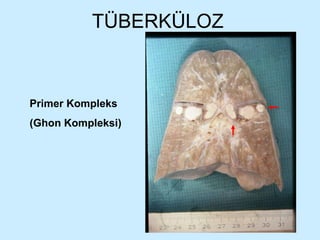 TÜBERKÜLOZ Primer Kompleks  (Ghon Kompleksi) 