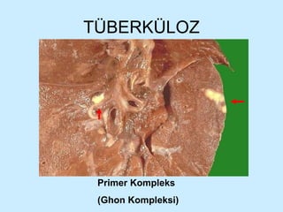 TÜBERKÜLOZ Primer Kompleks  (Ghon Kompleksi) 