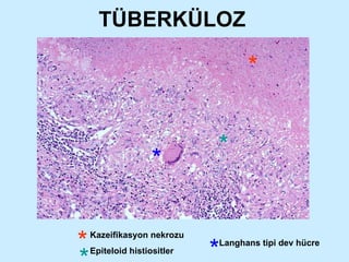 TÜBERKÜLOZ Kazeifikasyon nekrozu Epiteloid histiositler * * * * * * Langhans tipi dev hücre 