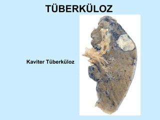 TÜBERKÜLOZ Kaviter Tüberküloz 