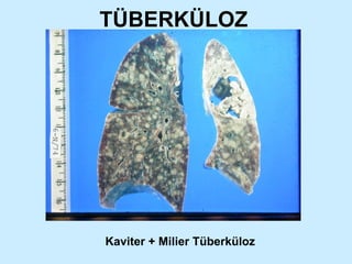 TÜBERKÜLOZ Kaviter + Milier Tüberküloz 