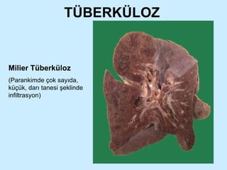 TÜBERKÜLOZ Milier Tüberküloz (Parankimde çok sayıda, küçük, darı tanesi şeklinde infiltrasyon) 