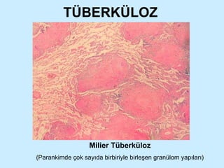 TÜBERKÜLOZ Milier Tüberküloz (Parankimde çok sayıda birbiriyle birleşen granülom yapıları) 