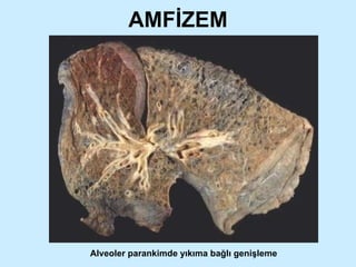 AMFİZEM Alveoler parankimde yıkıma bağlı genişleme 
