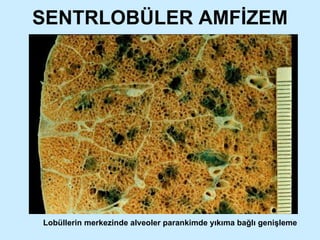 SENTRLOBÜLER AMFİZEM Lobüllerin merkezinde alveoler parankimde yıkıma bağlı genişleme 