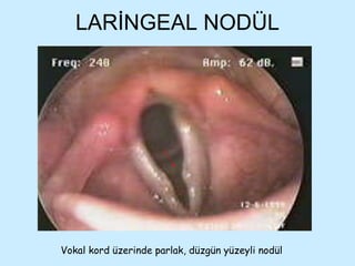 LARİNGEAL NODÜL Vokal kord üzerinde parlak, düzgün yüzeyli nodül 