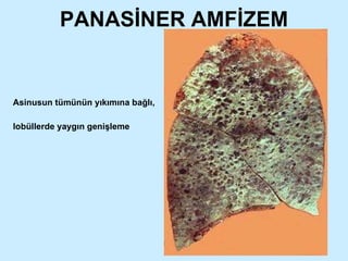PANASİNER AMFİZEM Asinusun tümünün yıkımına bağlı,  lobüllerde yaygın genişleme 