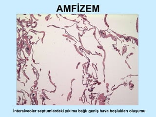 AMFİZEM İnteralveoler septumlardaki yıkıma bağlı geniş hava boşlukları oluşumu 