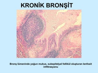 KRONİK BRONŞİT Bronş lümeninde yoğun mukus, subepitelyal follikül oluşturan lenfosit infiltrasyonu 