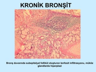 KRONİK BRONŞİT Bronş duvarında subepitelyal follikül oluşturan lenfosit infiltrasyonu, müköz glandlarda hiperplazi 
