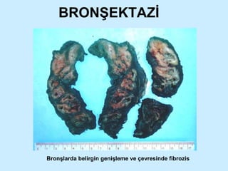 BRONŞEKTAZİ Bronşlarda belirgin genişleme ve çevresinde fibrozis 
