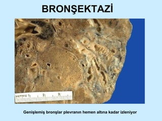 BRONŞEKTAZİ Genişlemiş bronşlar plevranın hemen altına kadar izleniyor 
