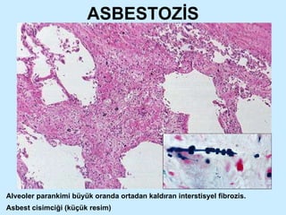 ASBESTOZİS Alveoler parankimi büyük oranda ortadan kaldıran interstisyel fibrozis.  Asbest cisimciği (küçük resim) 