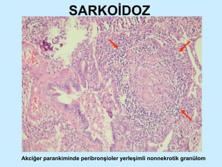 SARKOİDOZ Akciğer parankiminde peribronşioler yerleşimli nonnekrotik granülom 