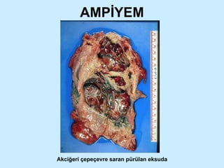 AMPİYEM Akciğeri çepeçevre saran pürülan eksuda 