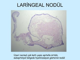 LARİNGEAL NODÜL Üzeri normal çok katlı yassı epitelle örtülü, subepitelyal bölgede hyalinizasyon gösteren nodül 