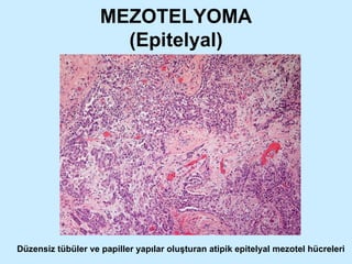 MEZOTELYOMA (Epitelyal) Düzensiz tübüler ve papiller yapılar oluşturan atipik epitelyal mezotel hücreleri 