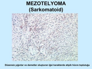 MEZOTELYOMA (Sarkomatoid) Düzensiz yığınlar ve demetler oluşturan iğsi karakterde atipik hücre topluluğu 