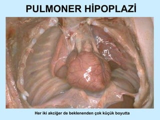 PULMONER HİPOPLAZİ Her iki akciğer de beklenenden çok küçük boyutta 
