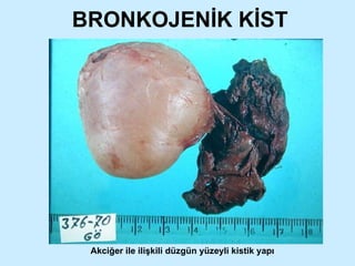 BRONKOJENİK KİST Akciğer ile ilişkili düzgün yüzeyli kistik yapı 