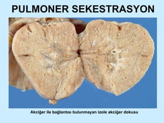 PULMONER SEKESTRASYON Akciğer ile bağlantısı bulunmayan izole akciğer dokusu 