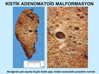 KİSTİK ADENOMATOİD MALFORMASYON Akciğerde çok sayıda küçük kistik yapı, kistler arasındaki parankim normal 