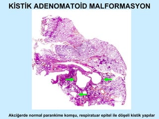 KİSTİK ADENOMATOİD MALFORMASYON Akciğerde normal parankime komşu, respiratuar epitel ile döşeli kistik yapılar 