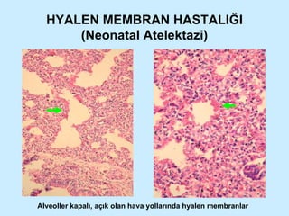 HYALEN MEMBRAN HASTALIĞI (Neonatal Atelektazi) Alveoller kapalı, açık olan hava yollarında hyalen membranlar 