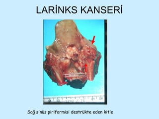 LARİNKS KANSERİ Sağ sinüs piriformisi destrükte eden kitle 