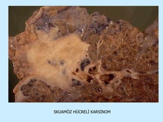 SKUAMÖZ HÜCRELİ KARSİNOM 
