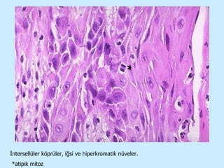 * İntersellüler köprüler, iğsi ve hiperkromatik nüveler. *atipik mitoz 