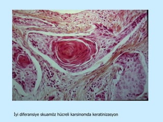 İyi diferansiye skuamöz hücreli karsinomda keratinizasyon 