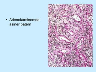 Adenokarsinomda asiner patern 