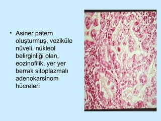 Asiner patern oluşturmuş, veziküle nüveli, nükleol belirginliği olan, eozinofilik, yer yer berrak sitoplazmalı adenokarsinom hücreleri 