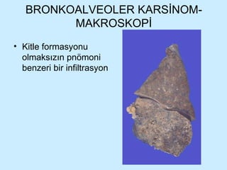 BRONKOALVEOLER KARSİNOM-MAKROSKOPİ Kitle formasyonu olmaksızın pnömoni benzeri bir infiltrasyon 