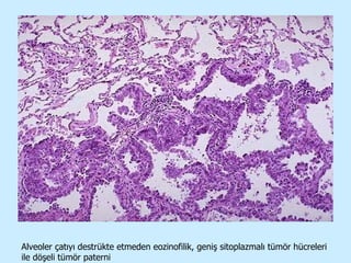 Alveoler çatıyı destrükte etmeden eozinofilik, geniş sitoplazmalı tümör hücreleri ile döşeli tümör paterni 