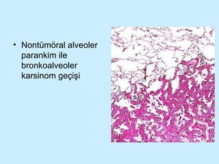 Nontümöral alveoler parankim ile bronkoalveoler karsinom geçişi 