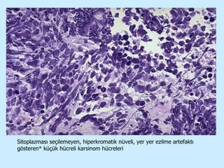 Sitoplazması seçilemeyen, hiperkromatik nüveli, yer yer ezilme artefaktı gösteren* küçük hücreli karsinom hücreleri * 