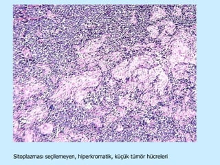 Sitoplazması seçilemeyen, hiperkromatik, küçük tümör hücreleri 