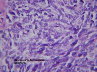 Nukleuslarda tuz karabiber görünümü 