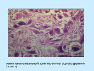 Hemen hemen tümü pleomorfik tümör hücrelerinden oluşmakta (pleomorfik karsinom) 