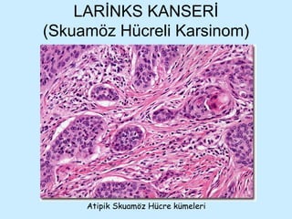LARİNKS KANSERİ (Skuamöz Hücreli Karsinom) Atipik Skuamöz Hücre kümeleri 