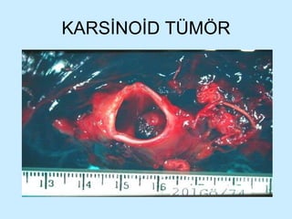 KARSİNOİD TÜMÖR 