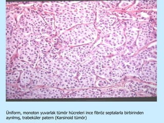 Üniform, monoton yuvarlak tümör hücreleri ince fibröz septalarla birbirinden ayrılmış, trabeküler patern (Karsinoid tümör) 