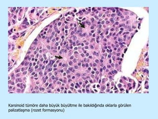 Karsinoid tümöre daha büyük büyültme ile bakıldığında oklarla görülen palizatlaşma (rozet formasyonu) 