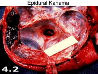 Epidural Kanama 
