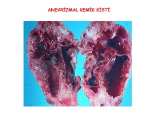 * ANEVRİZMAL KEMİK KİSTİ 