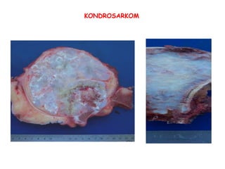 KONDROSARKOM 