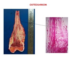 OSTEOSARKOM 