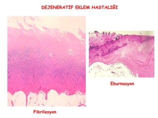 DEJENERATİF EKLEM HASTALIĞI Fibrilasyon Eburnasyon 